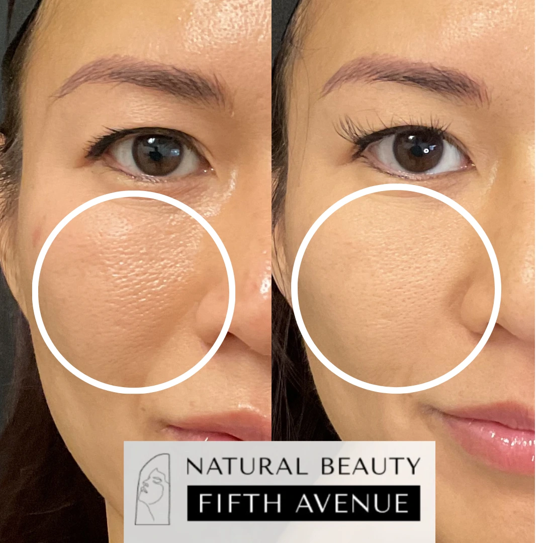 Before and after glass skin treatment showing improved skin texture and smoothness on cheek area